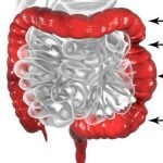 can ibs cause anemia