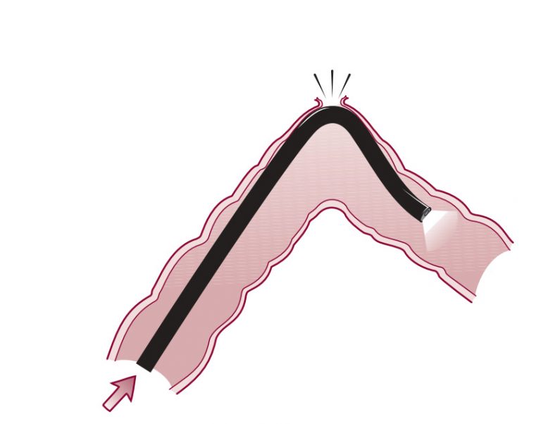 pain after colonoscopy polyp removal