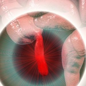 does appendicits cause diarrhea