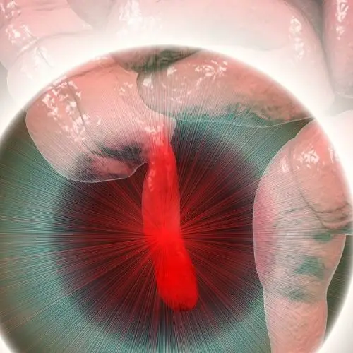 Does Appendicitis Cause Diarrhea? Gastroenterologist Explains. - Oh My Gut