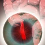 What causes appendix to burst