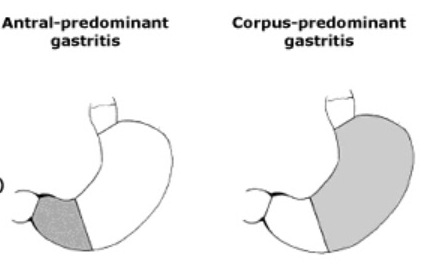 antral-predominant vs corpus-predominant gastritis.