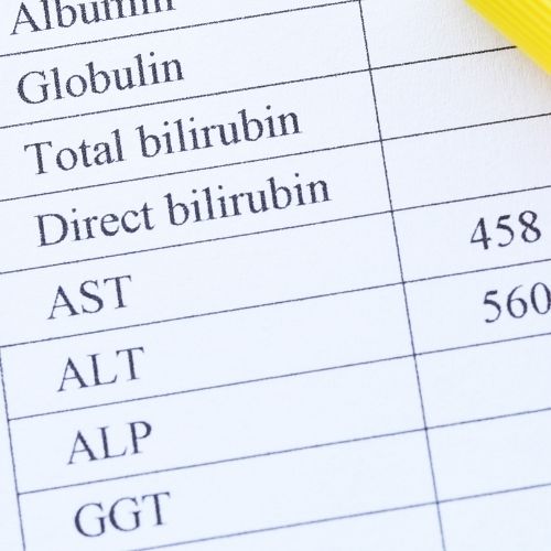 can gallstones cause high alt and ast levels.