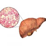 does fatty liver cause diarrhea or poop color changes?