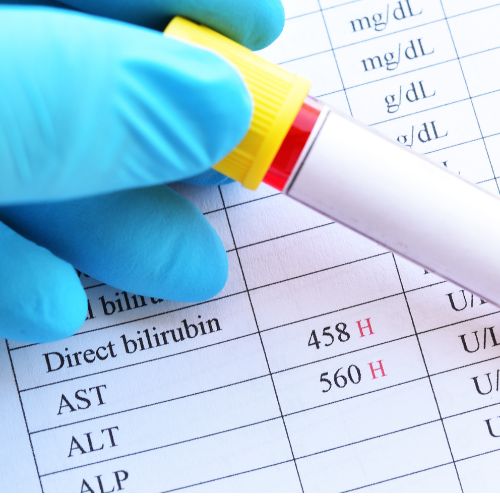 ast and alt levels in liver cirrhosis